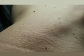 脸上、颈部、腋下的“肉疙瘩”是如何产生的？能用手抠掉吗？图片