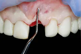 拔牙后24小时的注意事项，做好伤口更快愈合图片