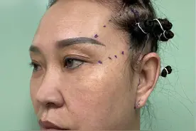 50岁亲身经历，不顾家人反对做大拉皮，30天身边熟人没敢认图片