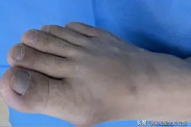 为什么尿酸降下来了痛风还会发作？医生辟谣，不该让降尿酸药背锅图片