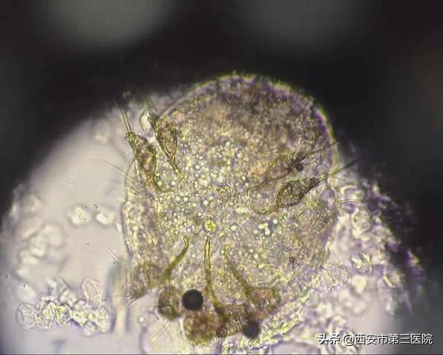 疥虱康宁一盒能用几天?（皮肤健康｜易被忽视的集体宿舍杀手疥疮）