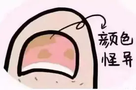 指甲出现这些症状，别不当回事！可能是灰指甲！做好早期预防图片