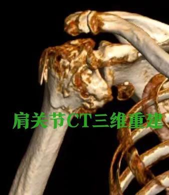 肱骨近端骨折系列之合并大结节撕脱性骨折治疗