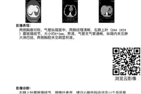 12岁女孩遭遇浸润性肺腺癌该如何？结节小病变早治愈率高图片
