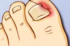 脚趾甲老往肉里钻，一碰还疼？教你小妙招，预防甲沟炎告别疼痛图片