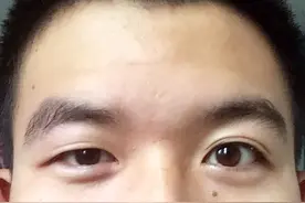 眼睛一大一小怎么办？图片