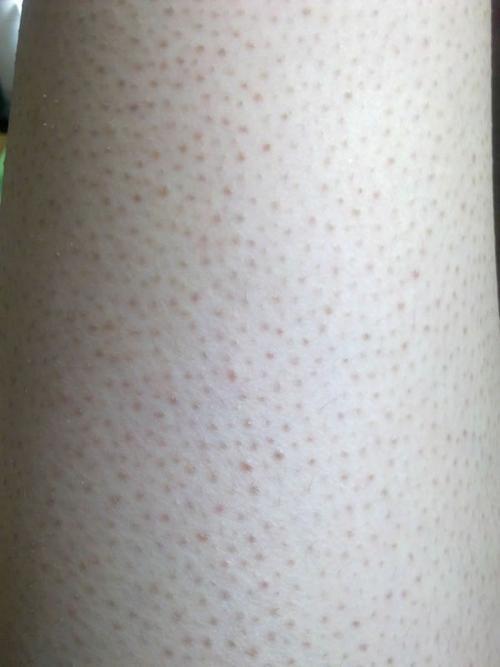 全身起鸡皮疙瘩的治疗