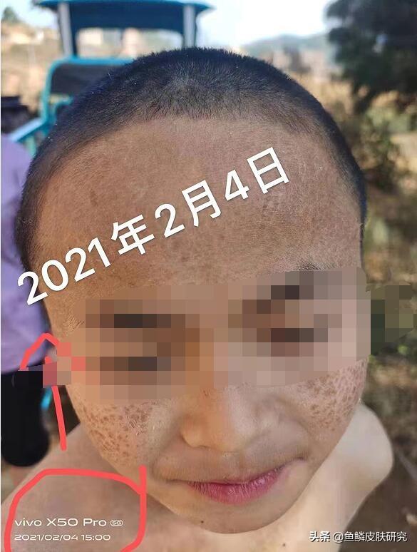 鱼鳞病跟鸡皮肤是一样的时候吗