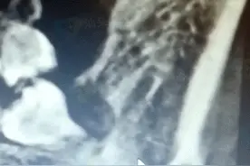 牙齿总咬到脸颊肉？女孩检查出阻生齿伴颌骨囊肿图片