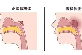 孩子睡觉老打鼾是睡得香？这是病，得治图片