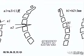 亲身经历过颈椎不稳，来谈谈我对颈椎不稳的认识总结图片