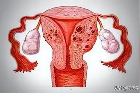 子宫腺肌瘤需要手术吗？图片