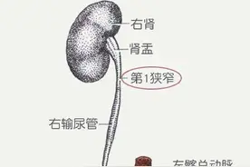 我与肾结石的斗争图片