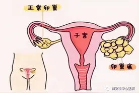 警惕女性沉默的杀手——卵巢癌图片
