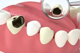 为什么补完牙后还会疼？自行对号入座，是不是以下这些原因导致的图片