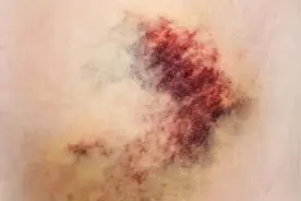 为什么身上总是有淤青？别忽视！可能是身体出现了问题图片