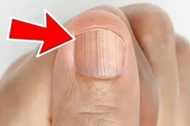 为什么指甲上有竖纹？指甲若出现4种异常，或是这几种问题的信号图片
