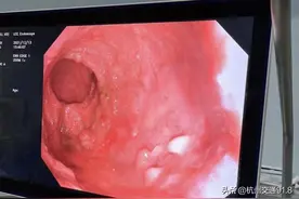 查出的“息肉”会不会变成肿瘤？杭州医生建议这些人群每年查一下肠镜图片