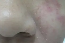 服用靶向药出现皮疹怎么办？从措施到预防管理1分钟全知道图片