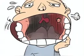嘴里长包，竟然是癌！浙一专家：这些习惯一定要改掉图片
