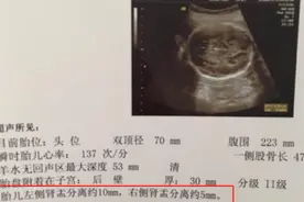 酸儿辣女、肾盂分离生男孩……那些判断性别的传言，有科学依据吗图片