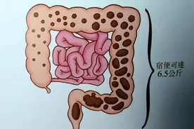 人体内有6公斤的宿便？怎样排出“赖着不走”的粪便？医生告诉你图片