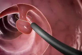 大肠癌与息肉有关？医生：若这2处“发臭”，或是大肠长了息肉图片