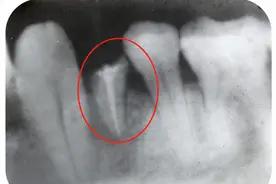 残根要不要拔掉？听听专业医生的分析图片