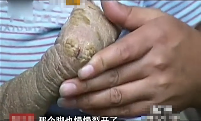 弥漫性表皮松懈角化症