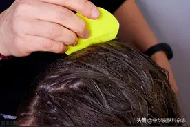 头上长虱子，该如何治疗？图片