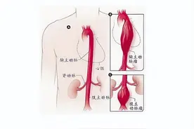 身体发出这2个“信号”，可能是主动脉扩张了图片