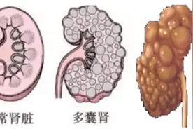肾囊肿「下」：关于多囊肾，你了解多少？图片
