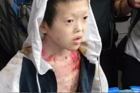 四川14岁保鲜膜男孩，皮肤普遍腐烂味道恶臭，医生：他是蝴蝶宝贝图片