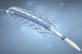 心脏支架手术到底是治病救人还是缺德害人？放了支架后能活几年？图片