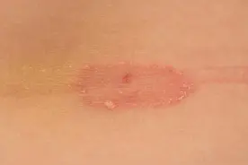 网恋男友第一次见面，酒店亲热时，发现我下身红肿，穿着裤衩就跑图片