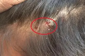 为什么头上经常起脓包和疙瘩？提醒：要考虑这3种情况图片