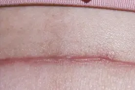 剖腹产疤痕增生反复凸起？过来人教你在家淡疤！顽固疤痕去无踪！图片