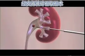 什么样的肾结石要在腰上打洞碎石？图片