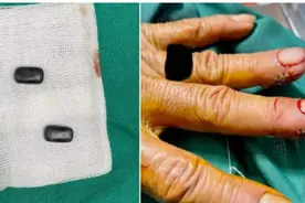 赌徒能有多疯狂？为了赢钱，男子在指尖缝入磁铁长达40年图片