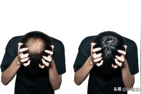 “脱发神药”米诺地尔凝胶为什么用起来没有效果呢？图片
