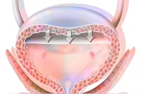 我为什么会有残余尿？图片