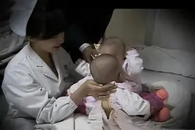 2009年，湖北一妈妈生下“连体女婴”，12年过去两个孩子咋样了？图片