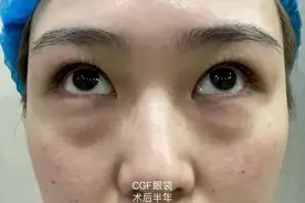 肿眼泡大眼袋黑眼圈等问题该如何解决？-眼袋熊师博士帮您解答图片