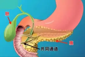胆源性胰腺炎患者是不是把胆切了就会好？专家说：不一定！图片