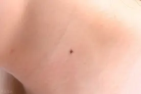 再三提醒：长在3个部位的痣，或与癌症“密切相关”，尽早处理图片