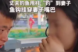 安徽芜湖 丈夫钓鱼甩钩直接钩妻子嘴巴上了图片
