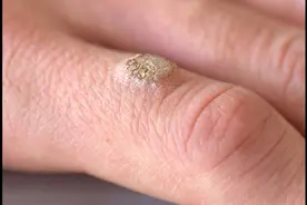 皮肤上的小肉球、小肉疙瘩是什么？“元凶”可能有3个，提高警惕图片