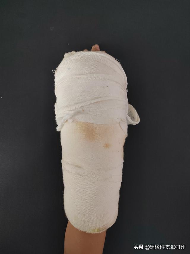 打了石膏痒怎么办