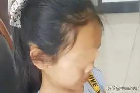 孩子脸上长虫斑，家长以为要驱虫，其实这叫白色糠疹图片