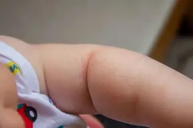 痒~痒~痒~属于夏天的是与“痱”图片